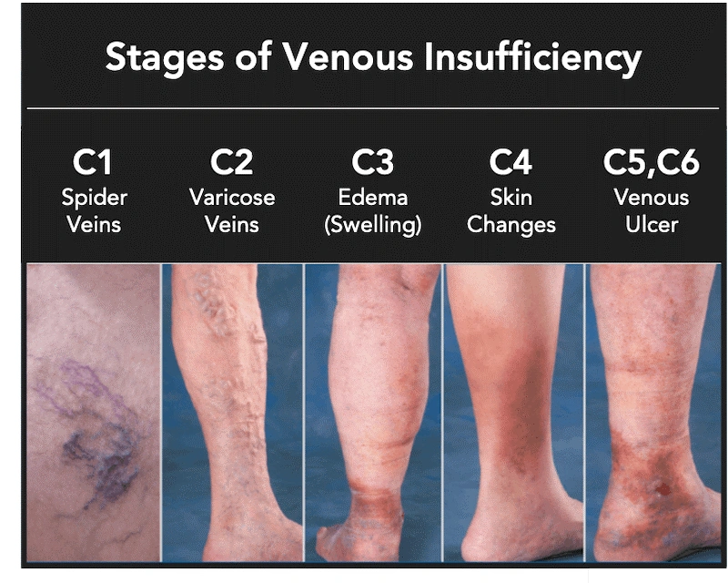 Stages Chronic Venous Insufficiency: