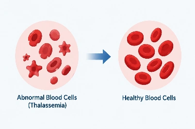 Thalassemia Stem Cell Transplant: HLA Matching